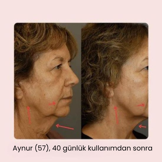 V-Line Yüz Germe Maskesi
