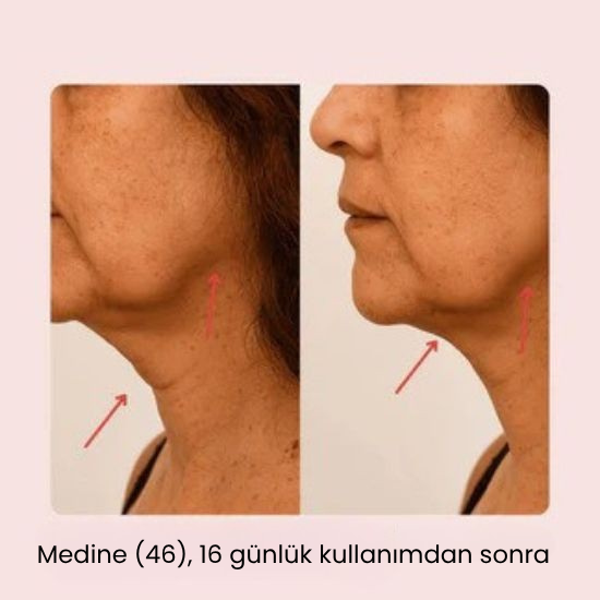 V-Line Yüz Germe Maskesi